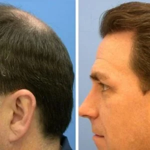 وفاة رجل خلال عملية زراعة شعر.. وخبراء يكشفون السبب