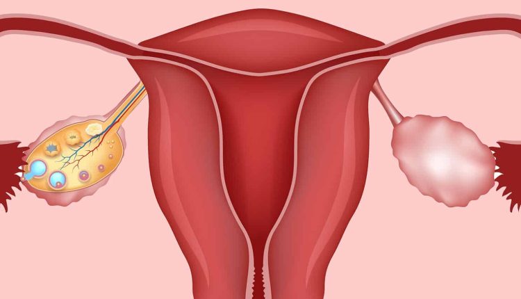 متلازمة المبيض متعدد الكيسات 